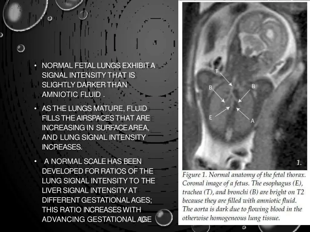 normal fetal lungs exhibit a signal intensity