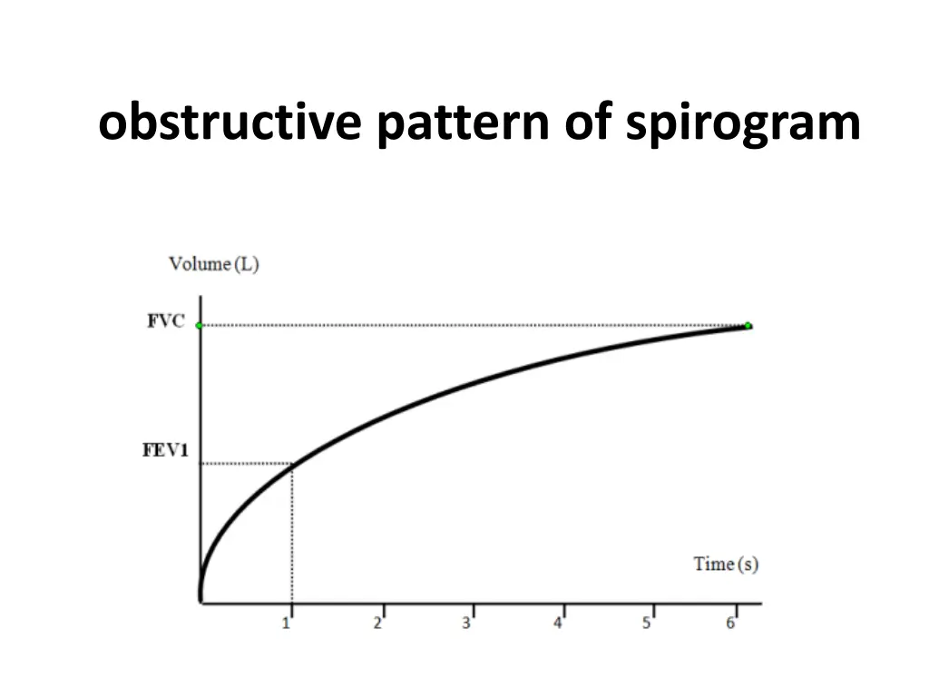 obstructive pattern of spirogram
