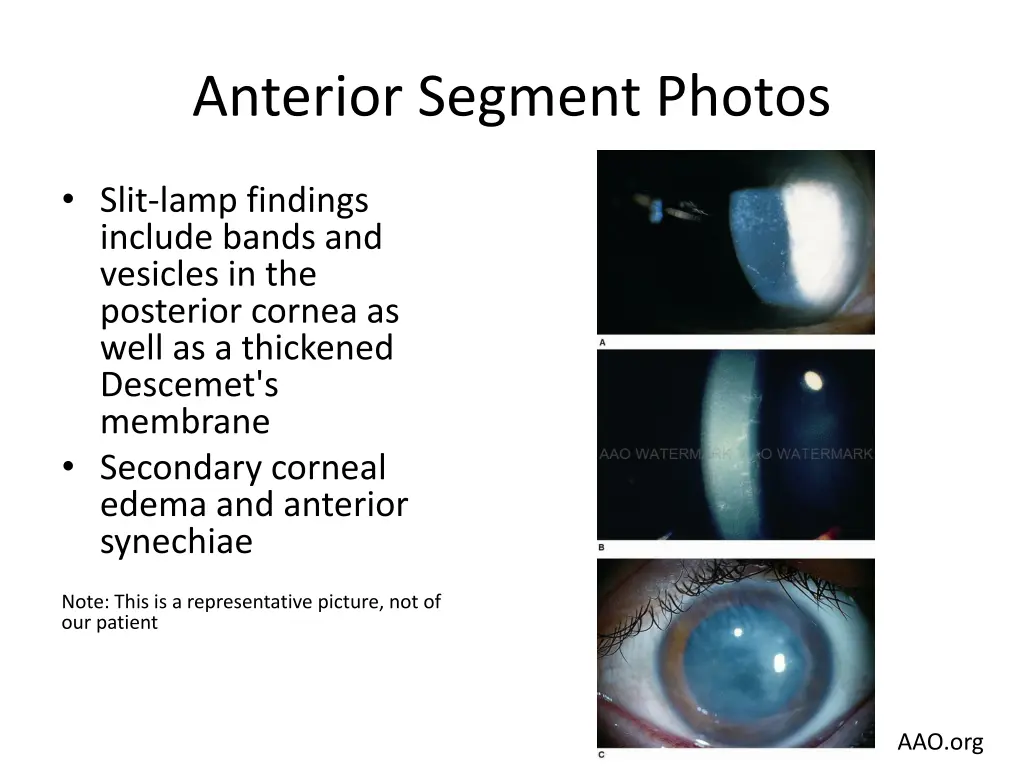 anterior segment photos