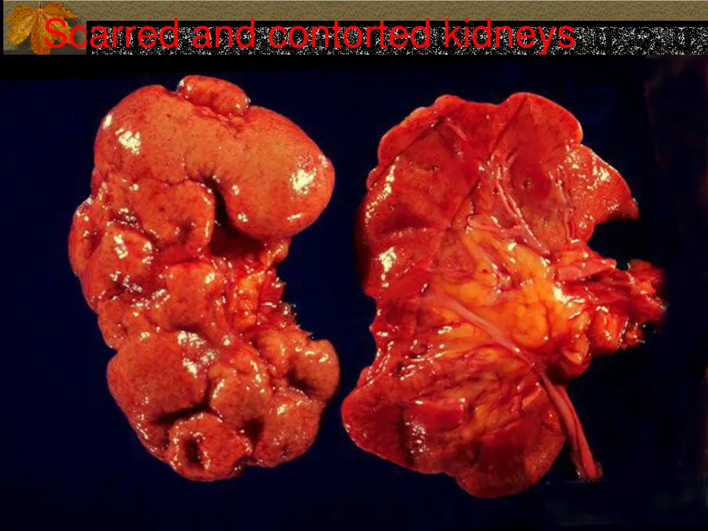 scarred and contorted kidneys