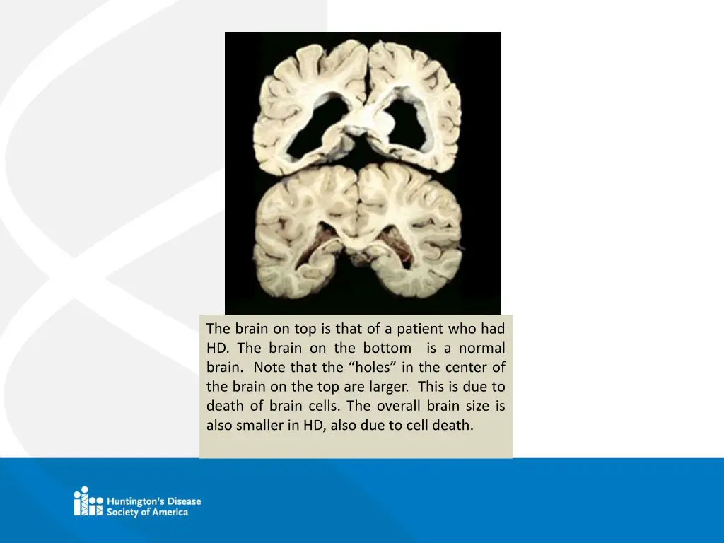 the brain on top is that of a patient