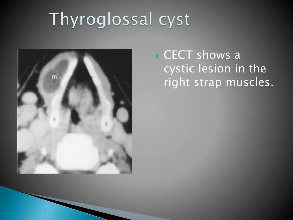 cect shows a cystic lesion in the right strap
