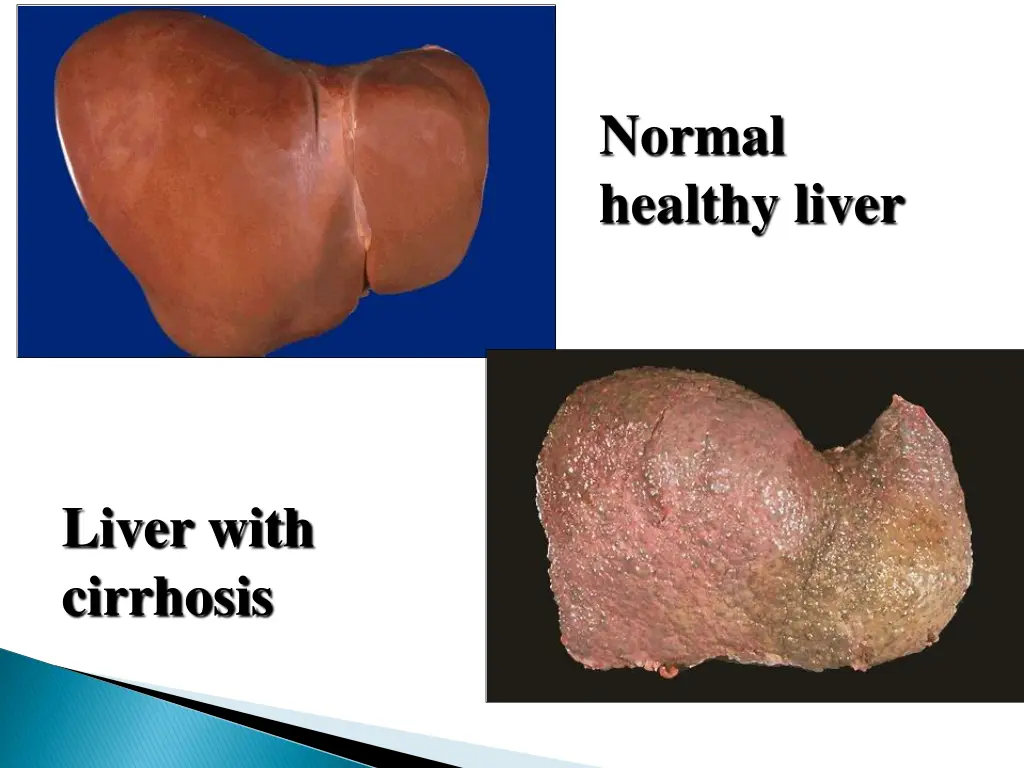 normal healthy liver