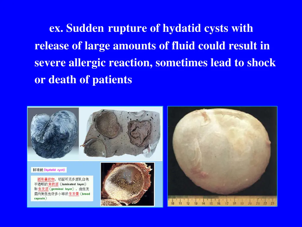 ex sudden rupture of hydatid cysts with release