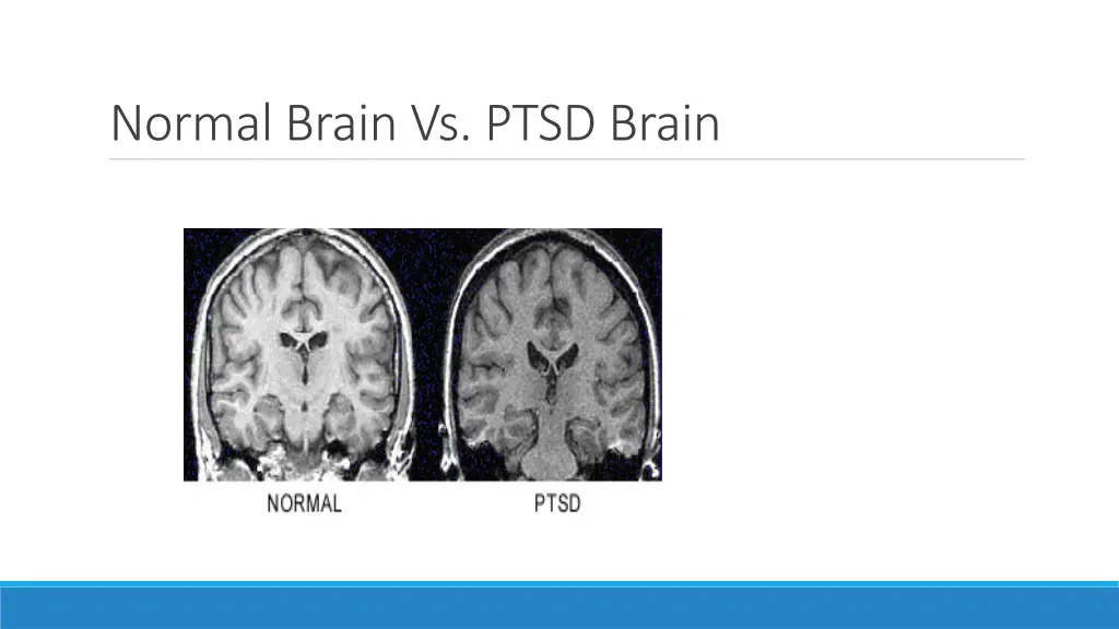 normal brain vs ptsd brain