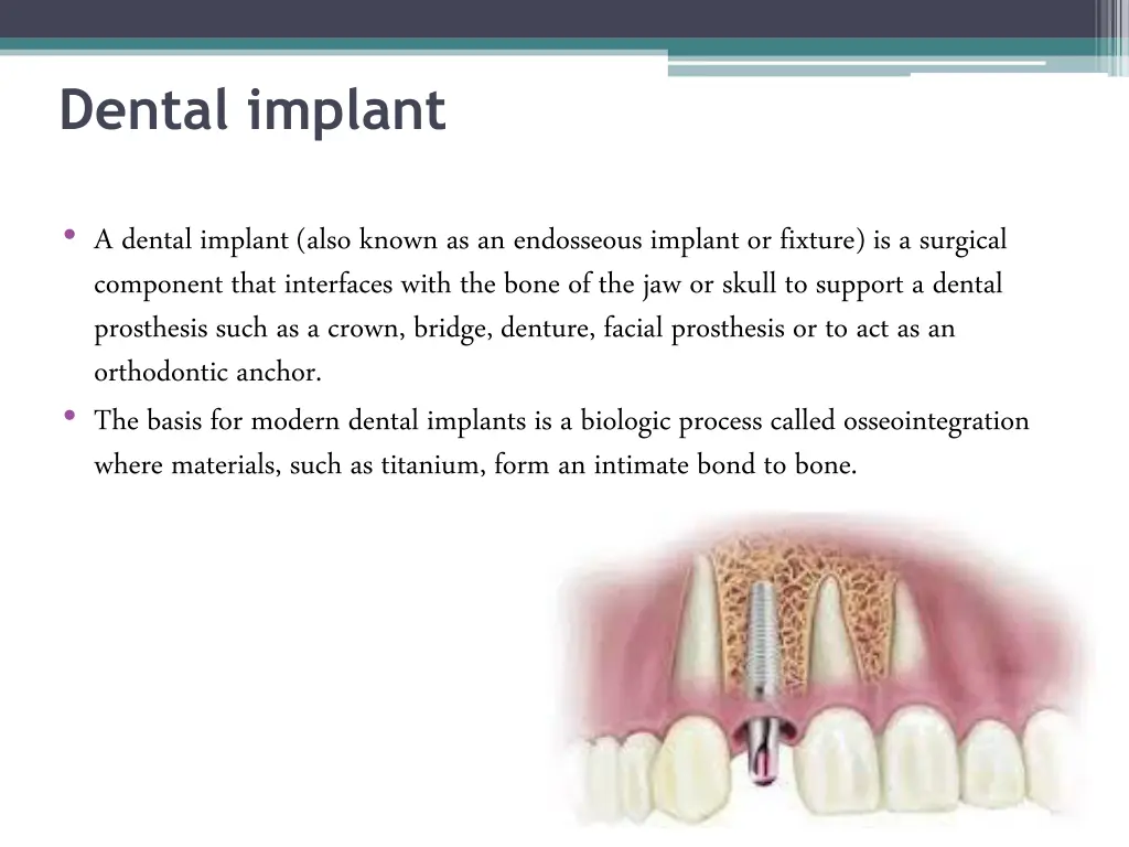 dental implant