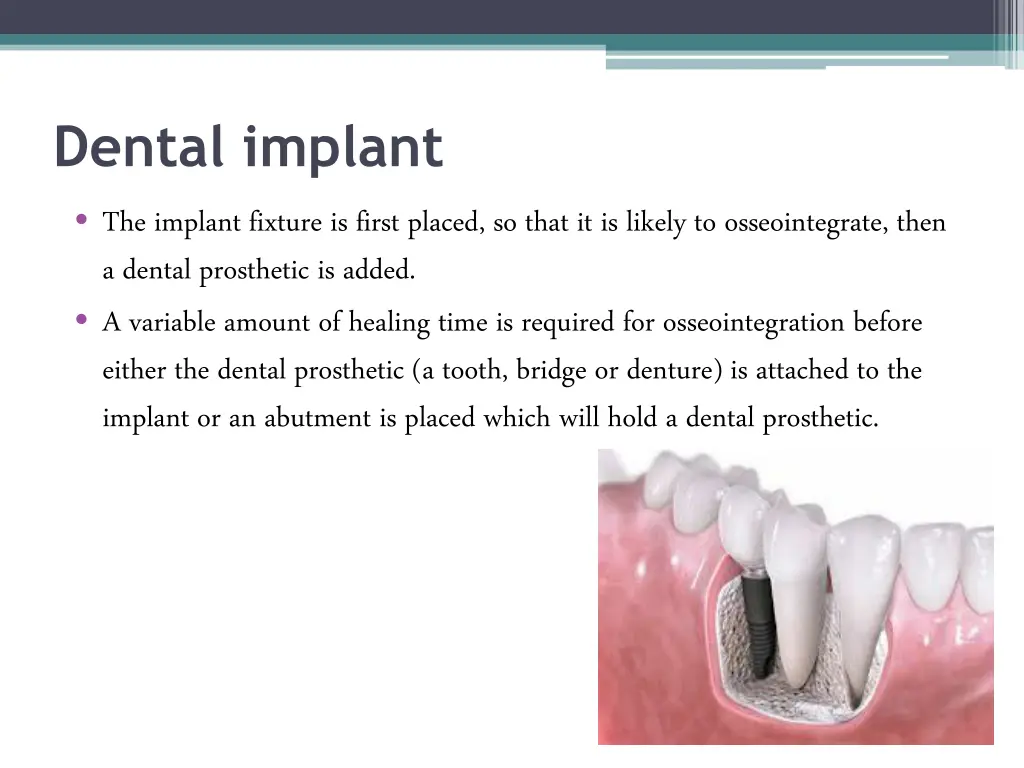 dental implant the implant fixture is first