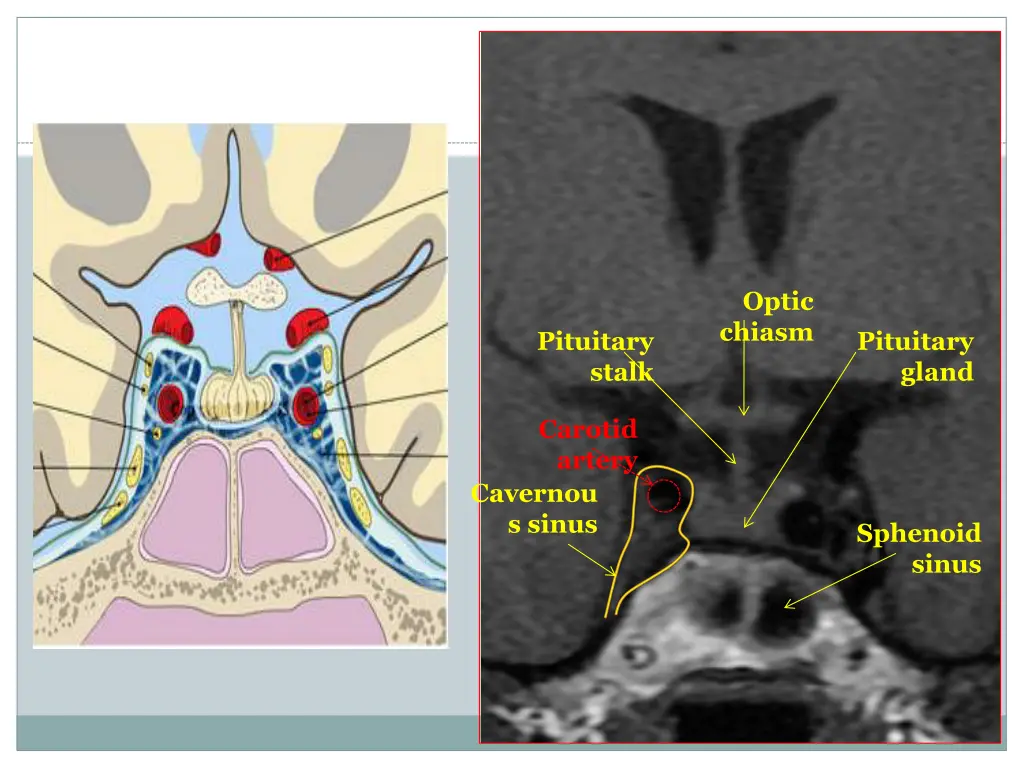 optic chiasm