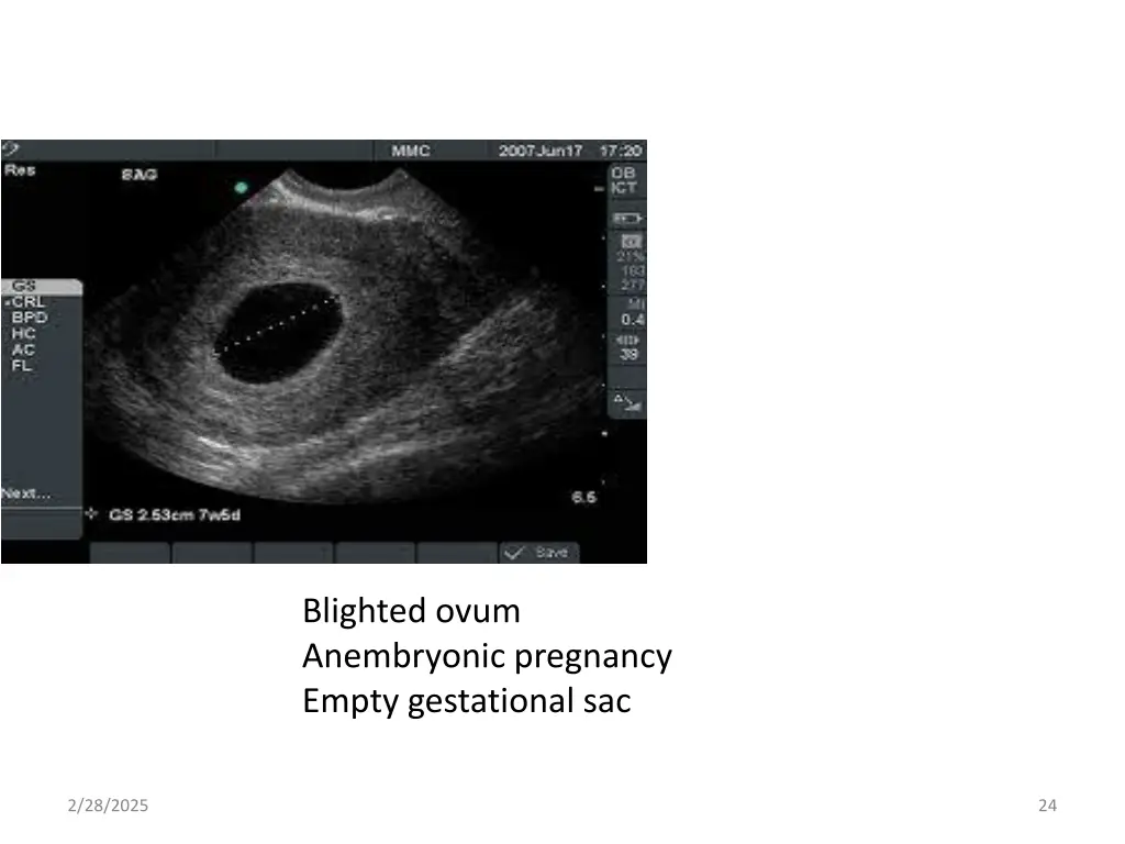 blighted ovum anembryonic pregnancy empty