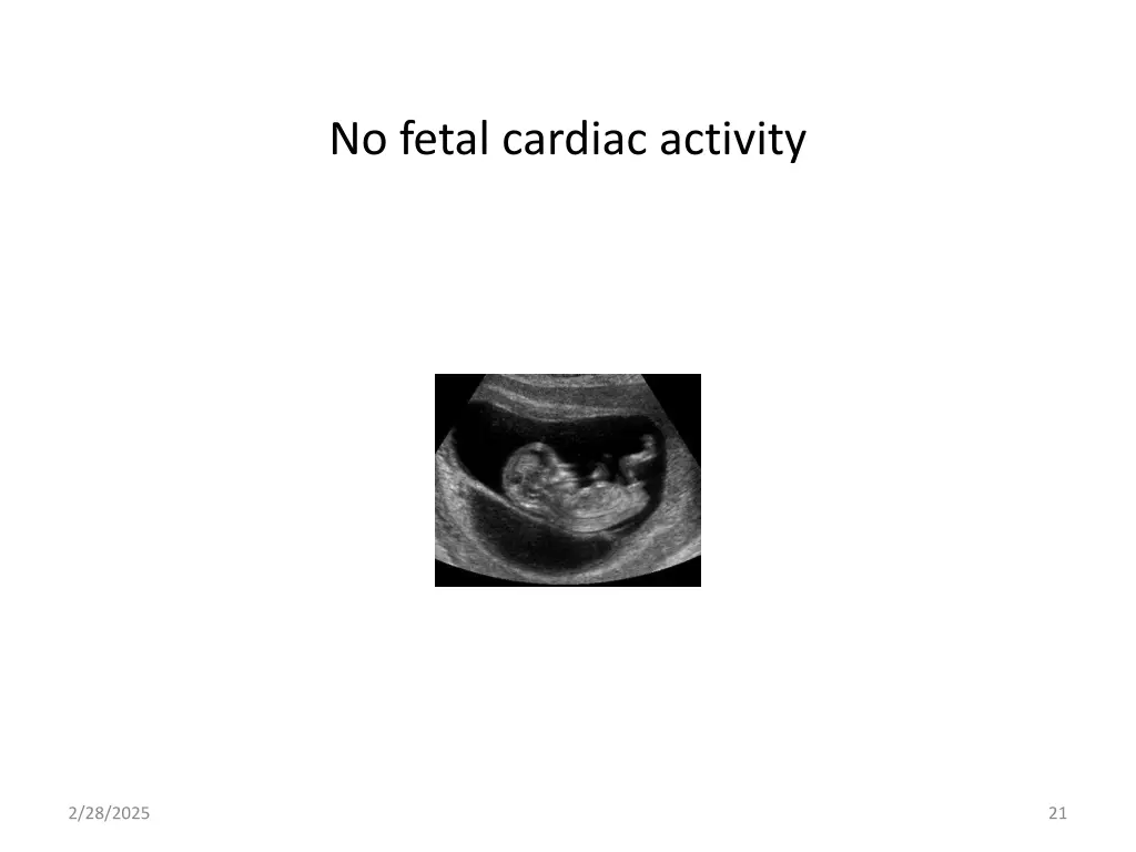 no fetal cardiac activity
