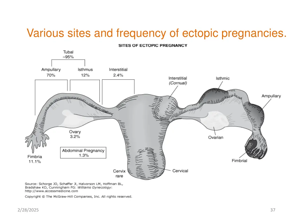 various sites and frequency of ectopic pregnancies