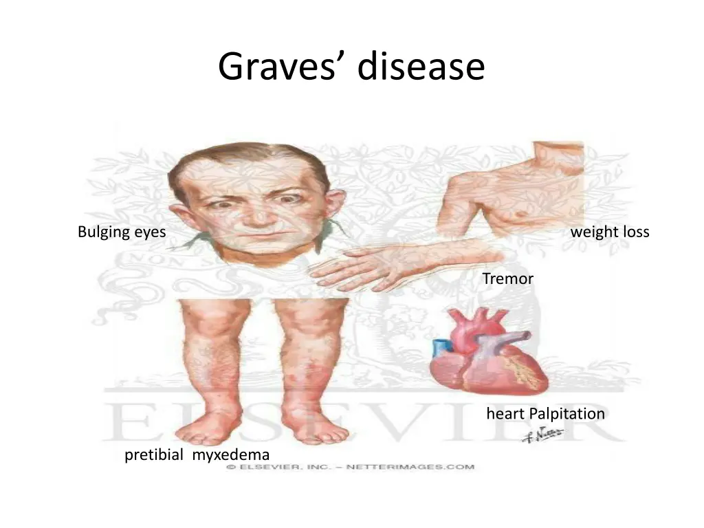graves disease 3