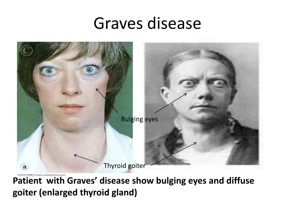 graves disease 4