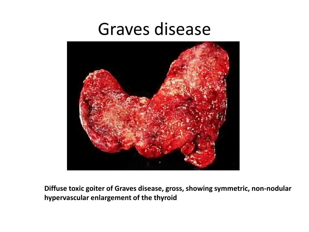 graves disease 5