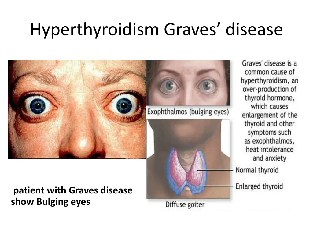 hyperthyroidism graves disease
