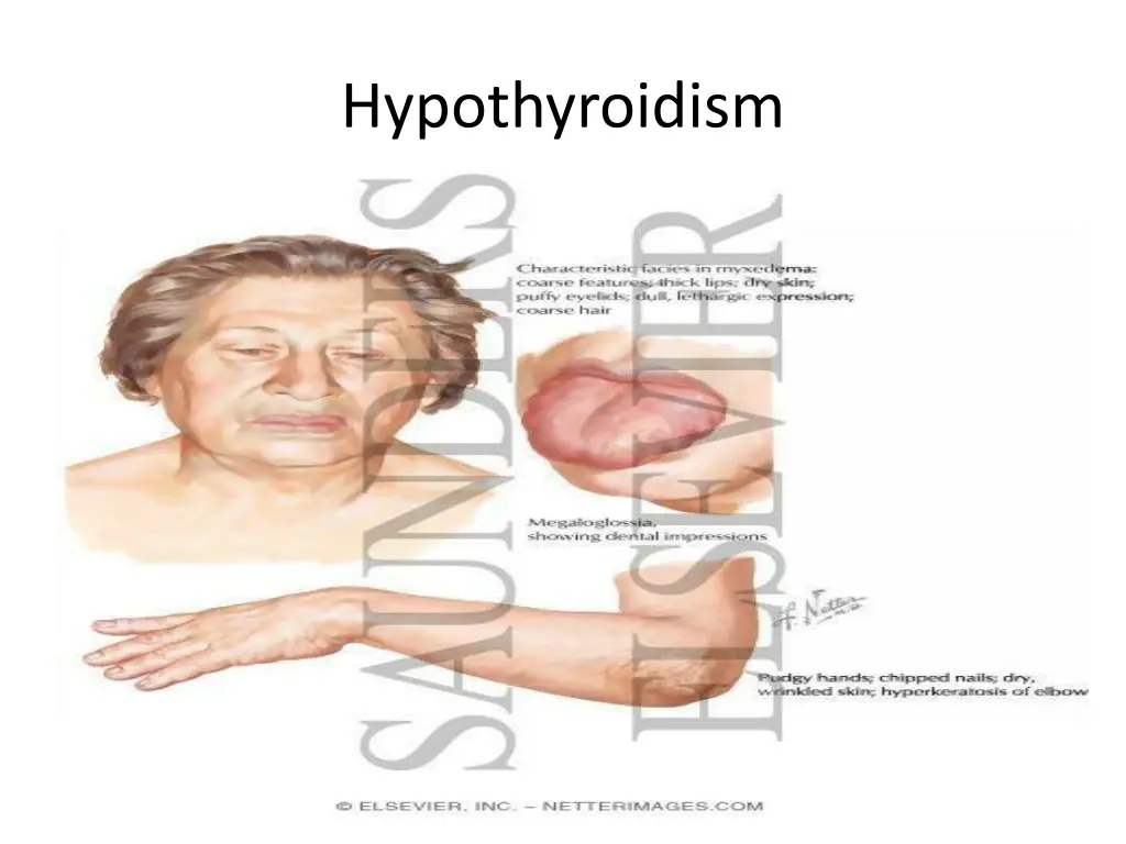 hypothyroidism 2