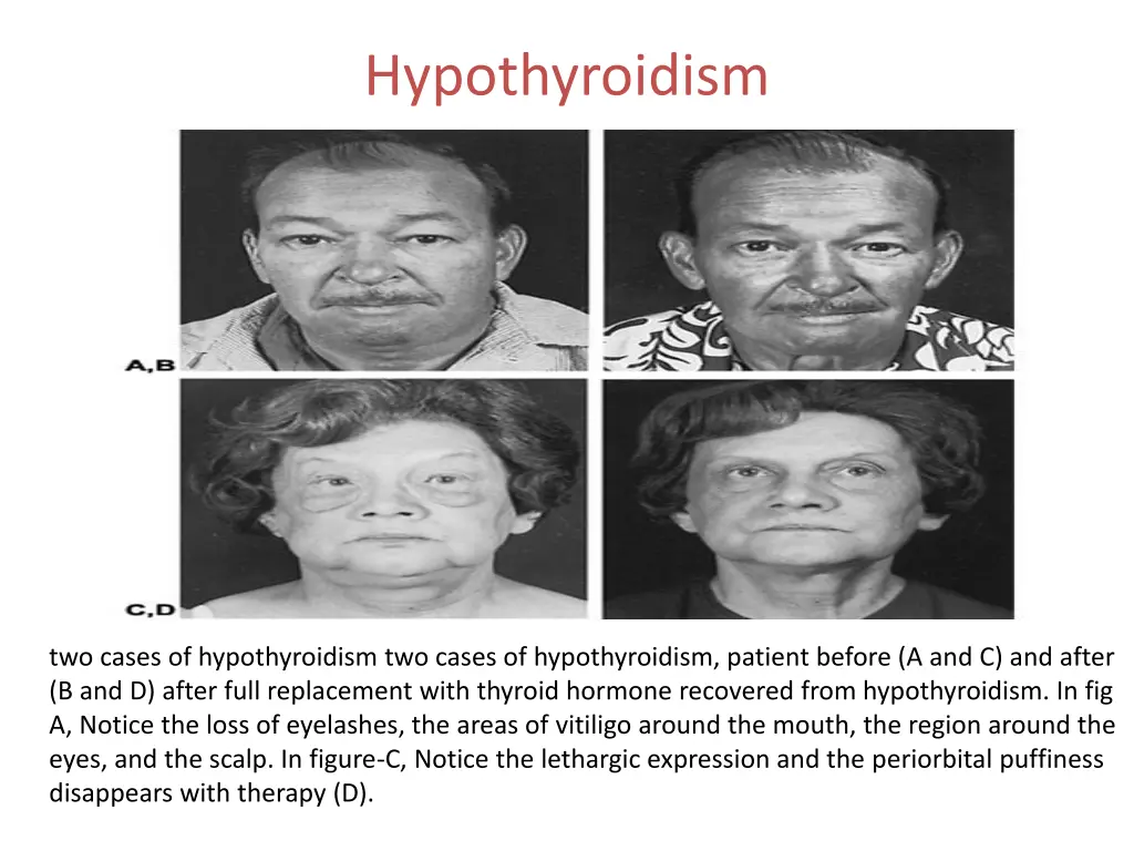 hypothyroidism 4