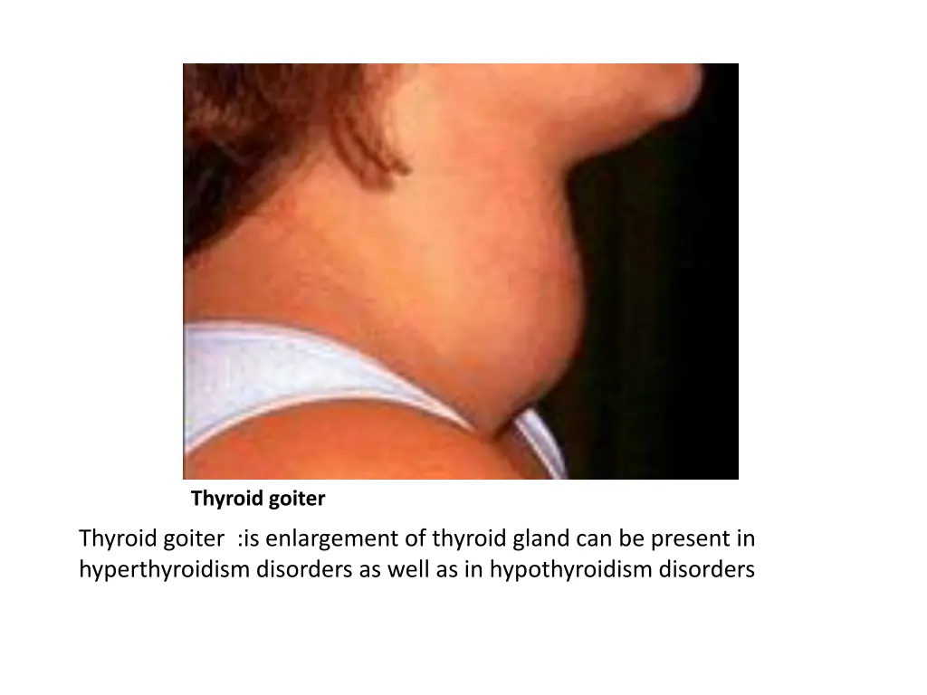 thyroid goiter