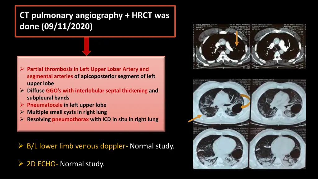 ct pulmonary angiography hrct was done 09 11 2020