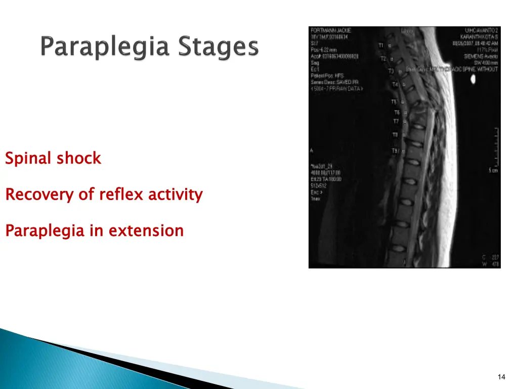 spinal shock