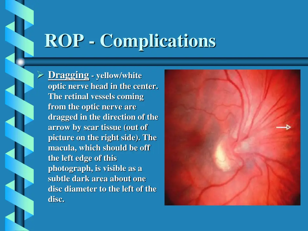 rop complications 1