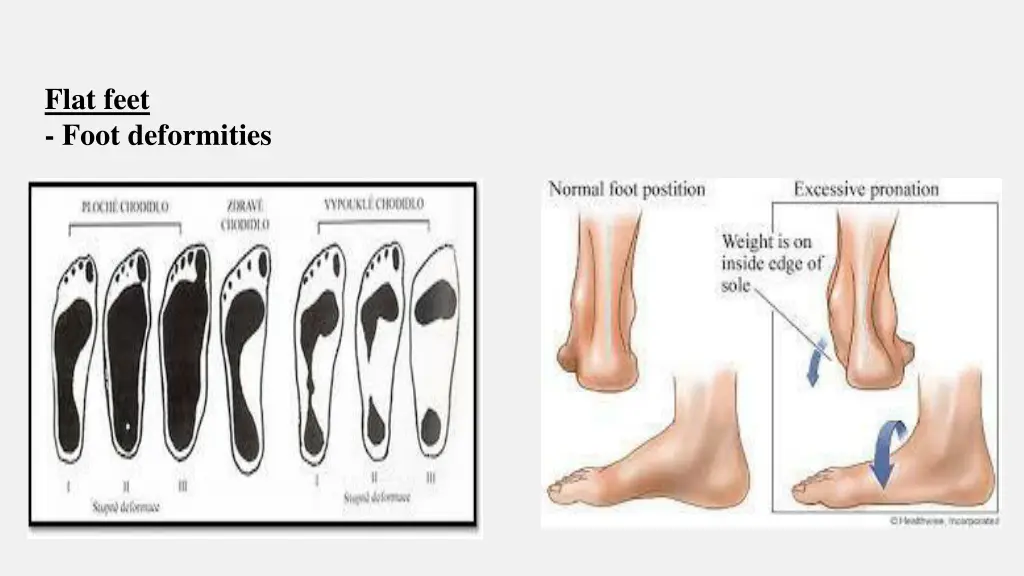 flat feet foot deformities