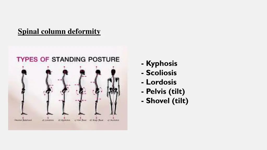 spinal column deformity