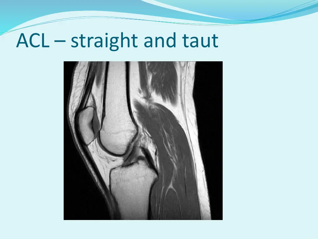 acl straight and taut