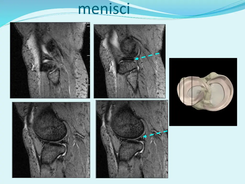 menisci
