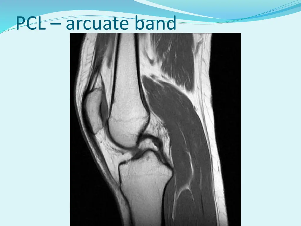 pcl arcuate band