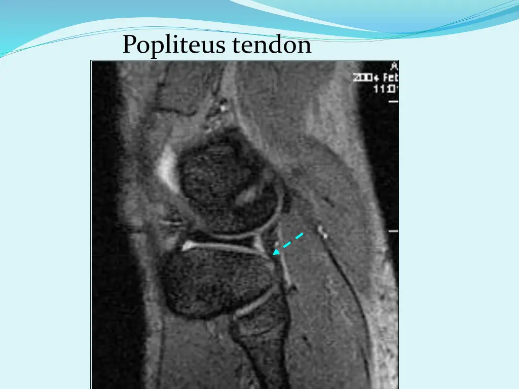 popliteus tendon