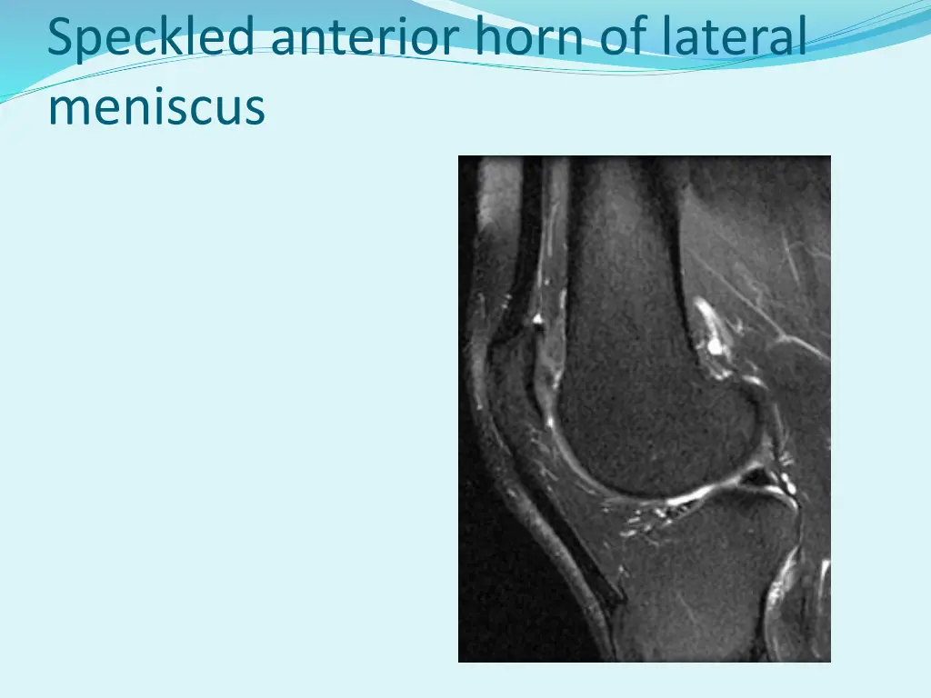 speckled anterior horn of lateral meniscus
