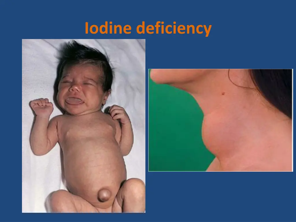 iodine deficiency 1