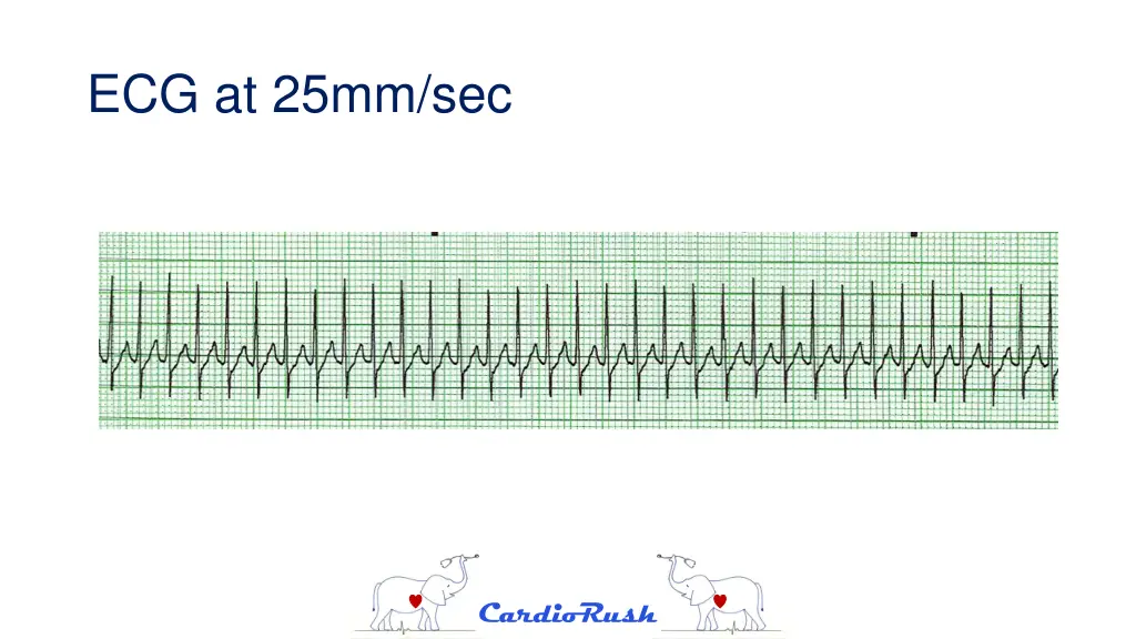 ecg at 25mm sec