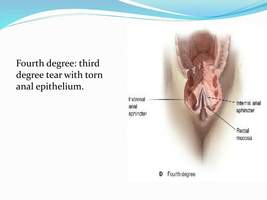 fourth degree third degree tear with torn anal