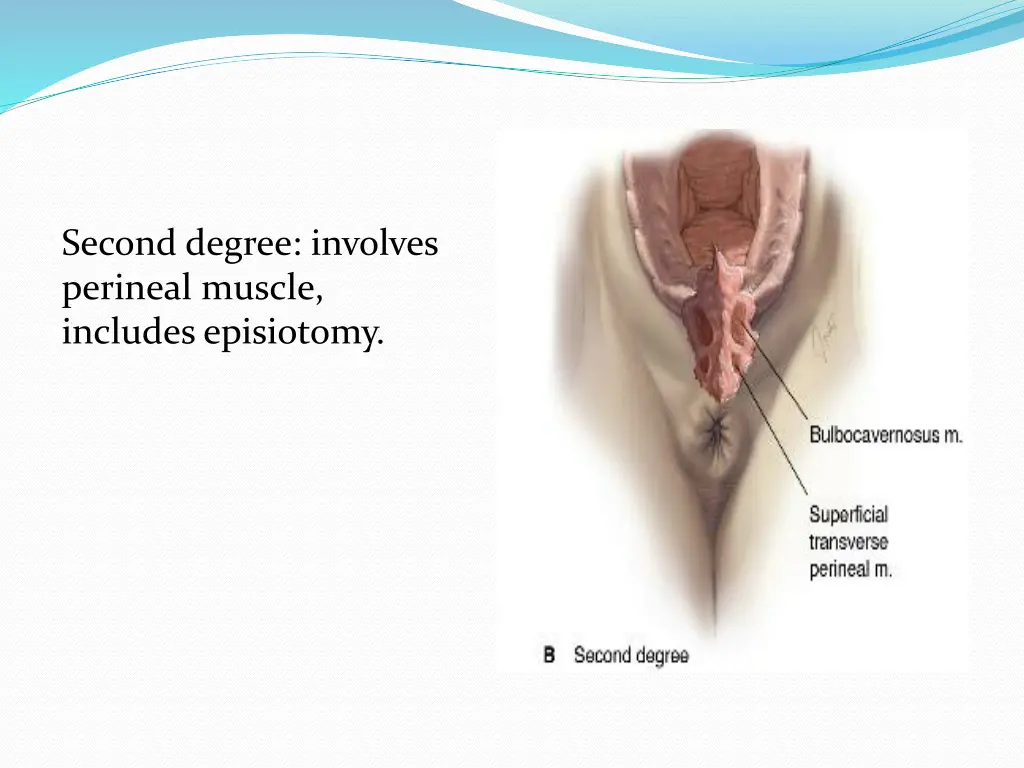 second degree involves perineal muscle includes
