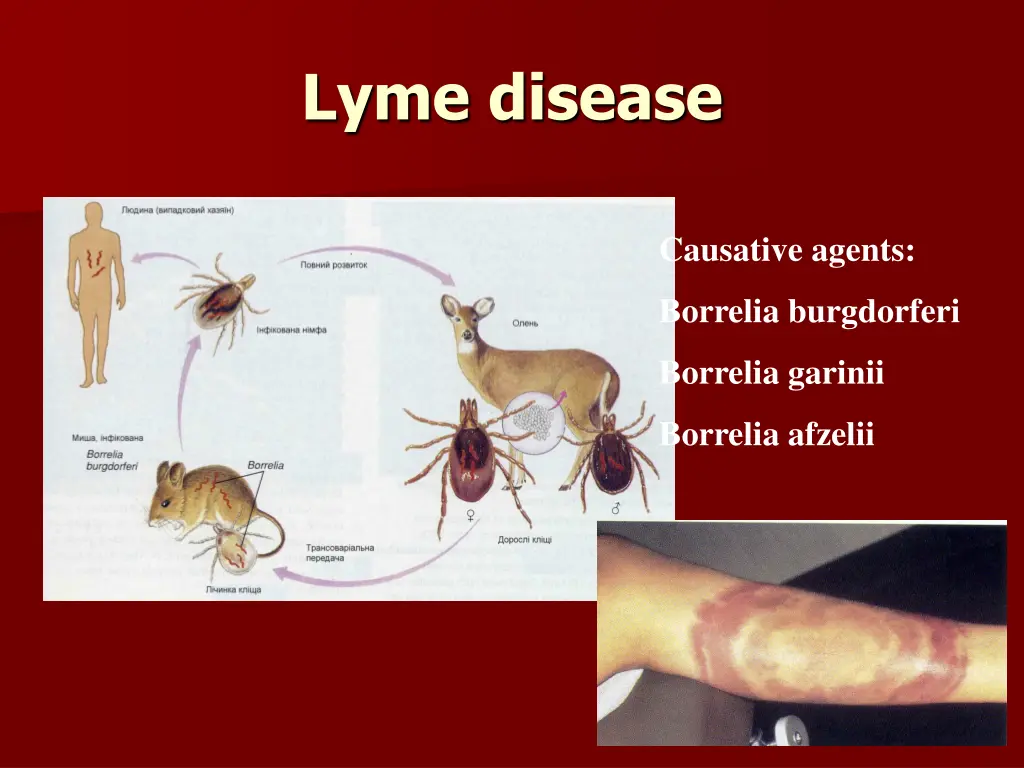 lyme disease