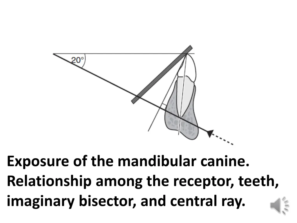 exposure of the mandibular canine relationship