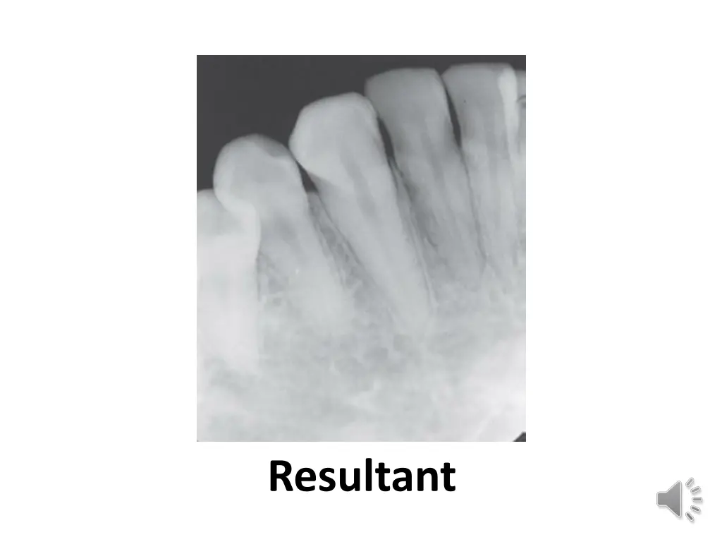 resultant