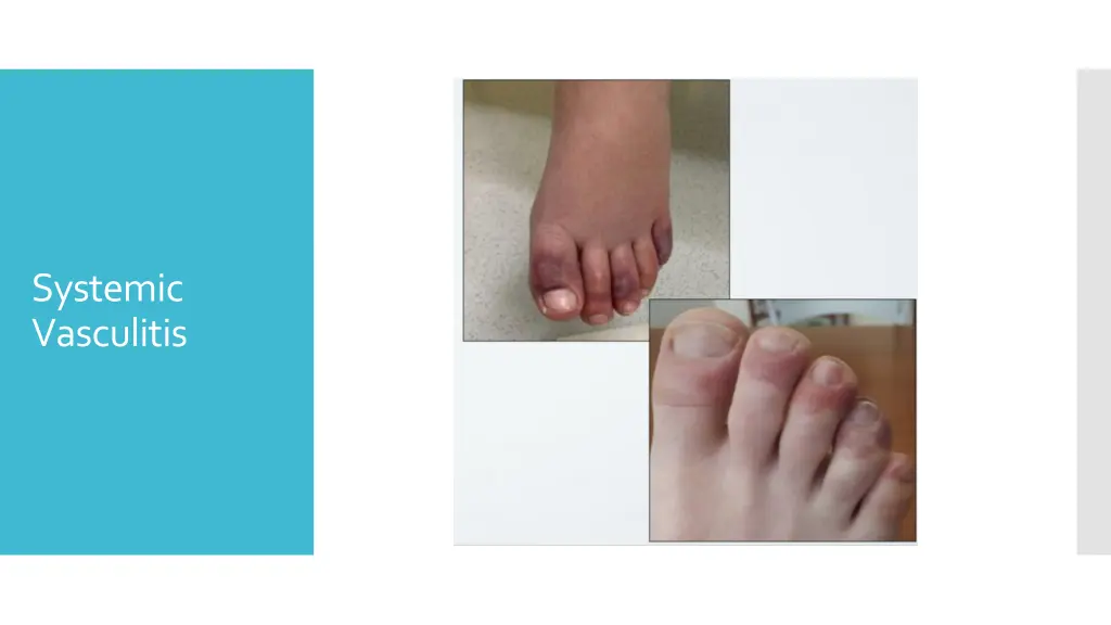 systemic vasculitis