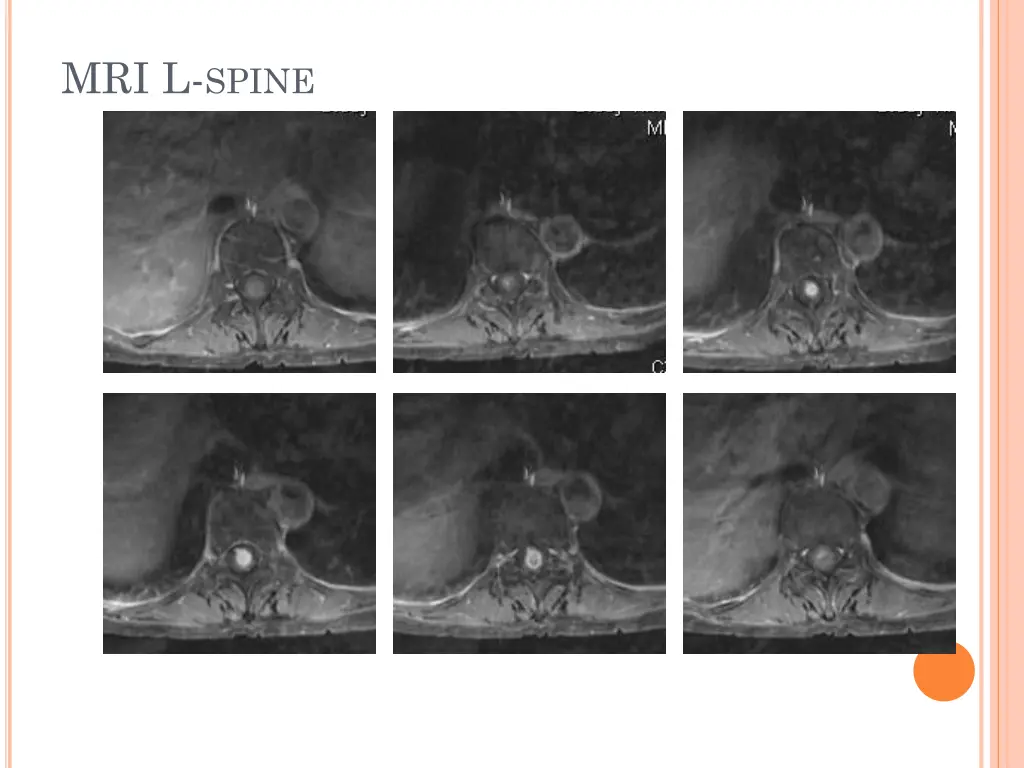 mri l spine 1