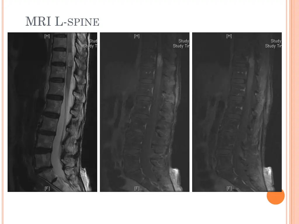 mri l spine