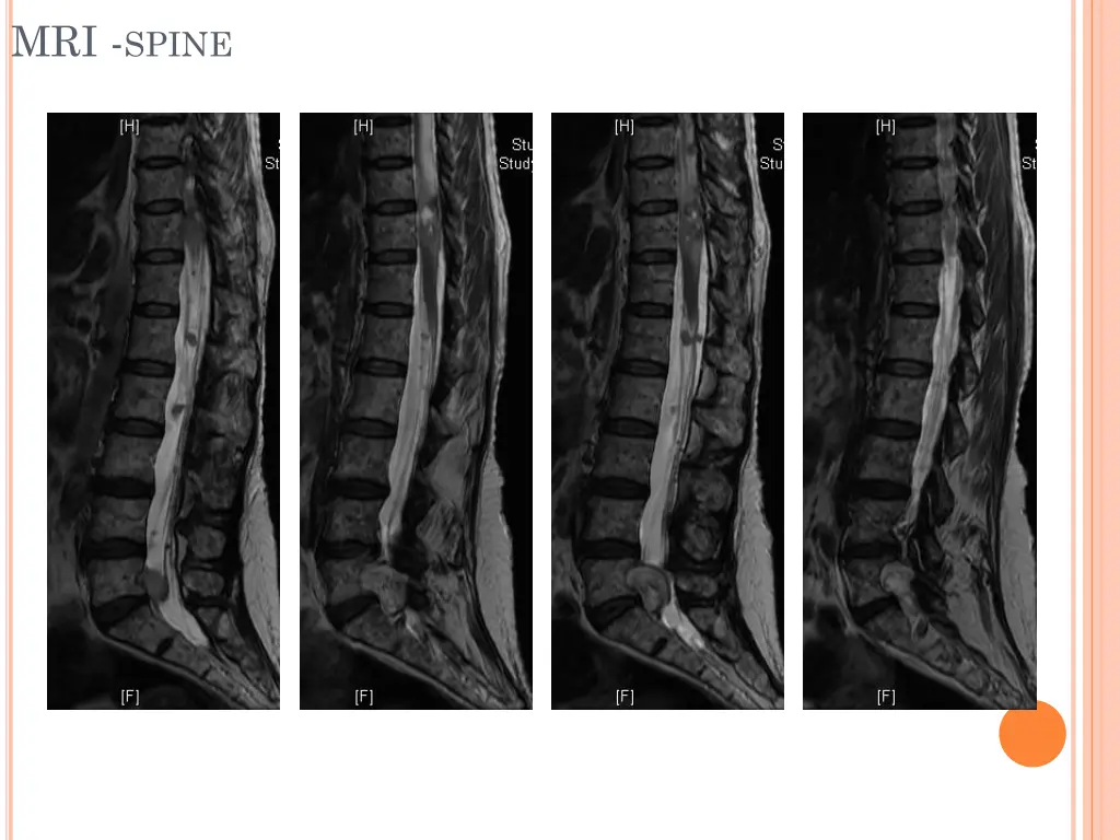 mri spine 1