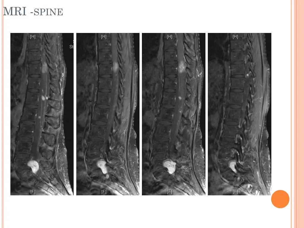 mri spine 2