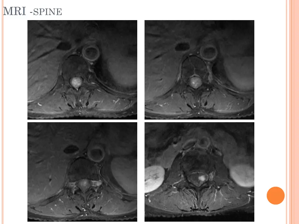 mri spine 3