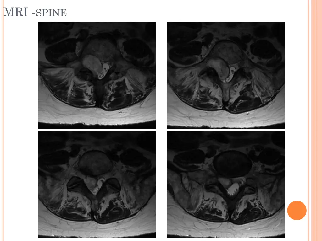 mri spine 4