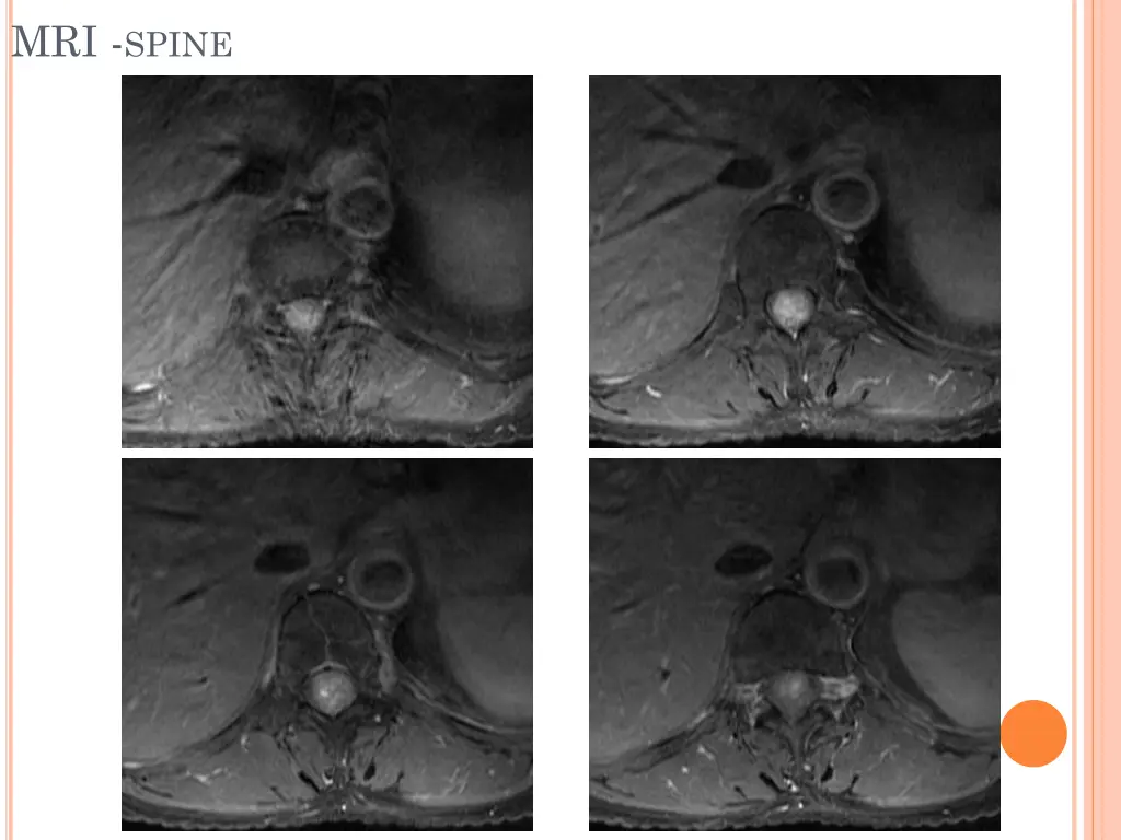 mri spine 5