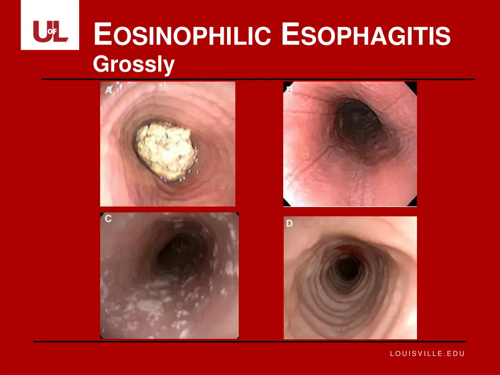 e osinophilic e sophagitis 6