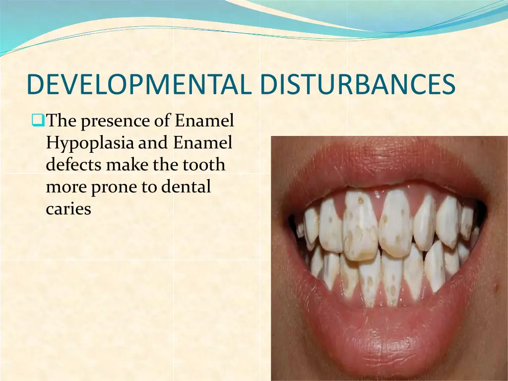 developmental disturbances the presence of enamel