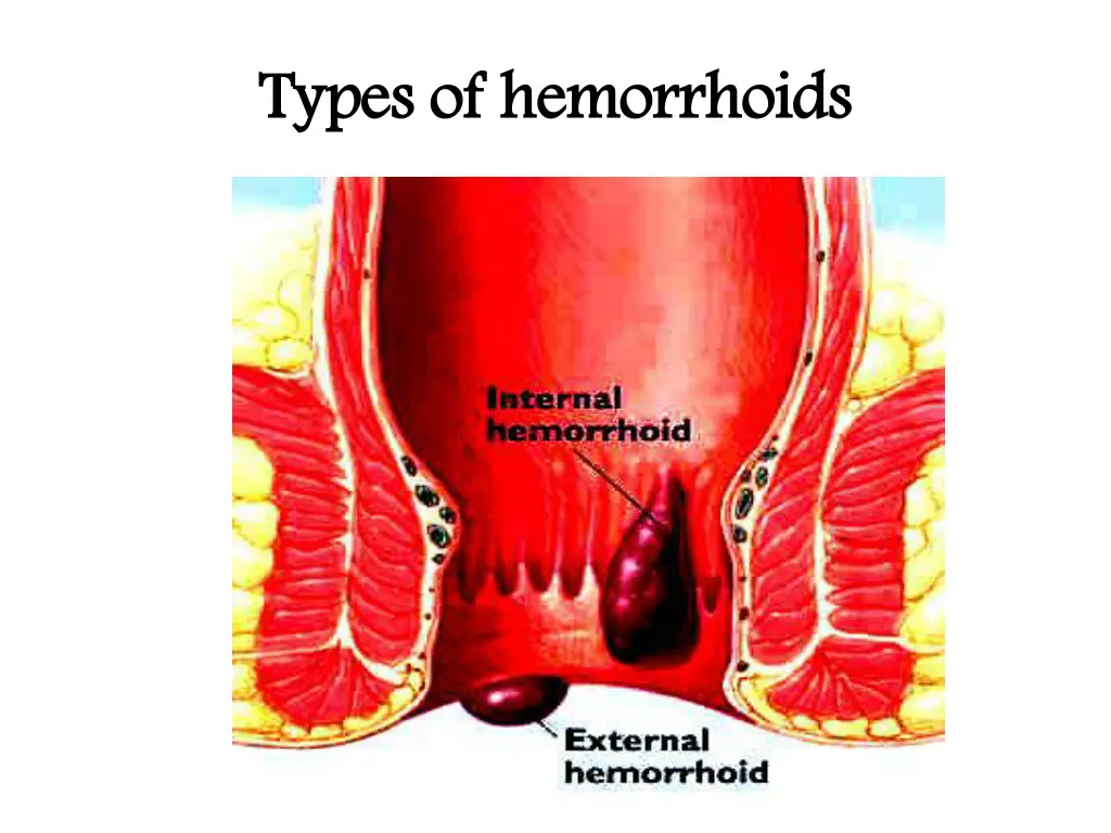 types of hemorrhoids